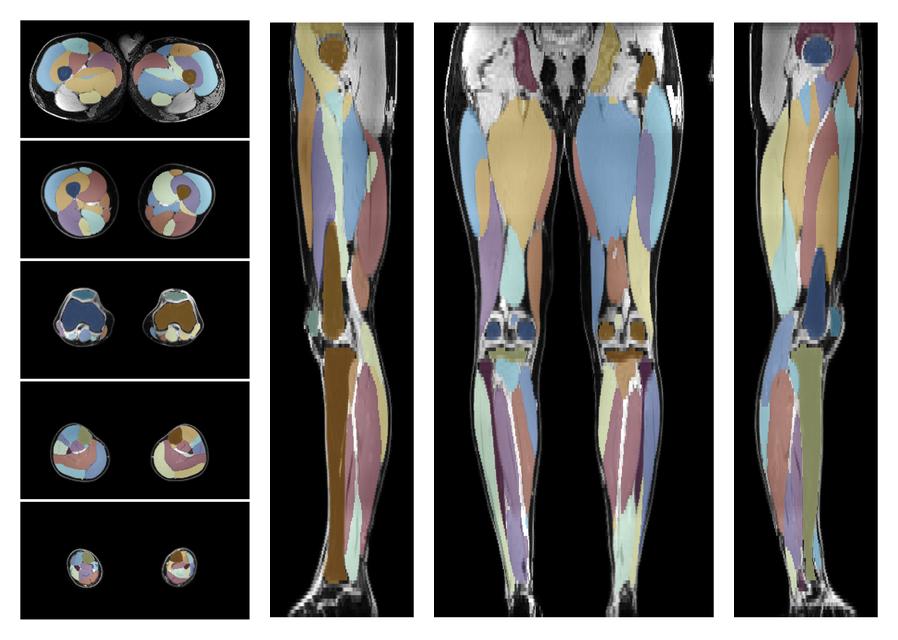 Overlay of automated muscle segmentation labels on dixon water image.